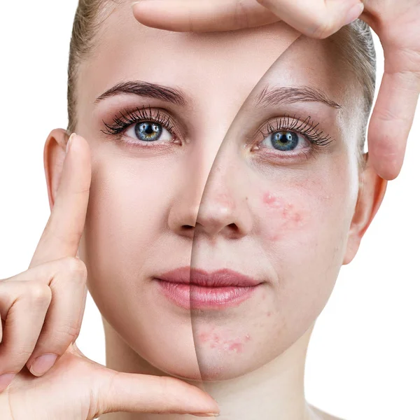 Mujer joven antes y después del tratamiento de la piel y maquillaje . — Foto de Stock