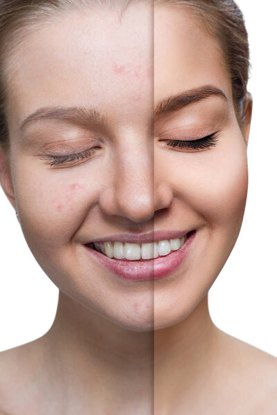 Young woman before and after skin treatment and makeup.