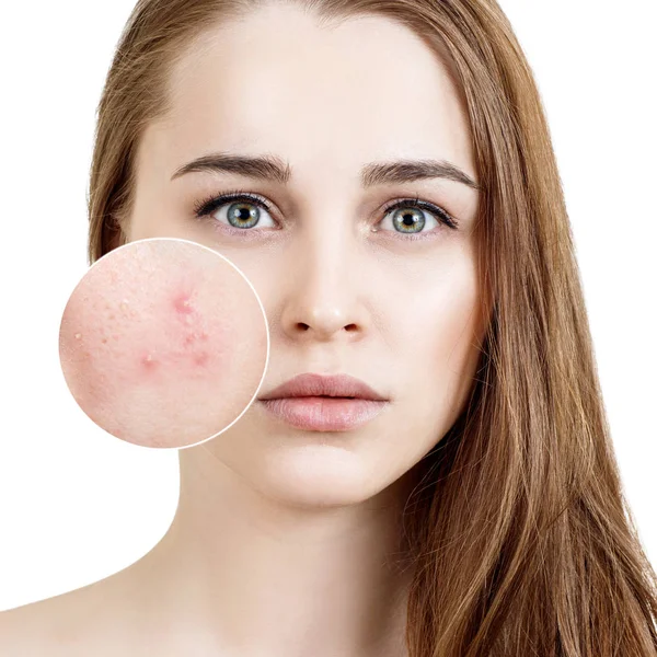 Young woman with acne skin in zoom circle. — Stock Photo, Image