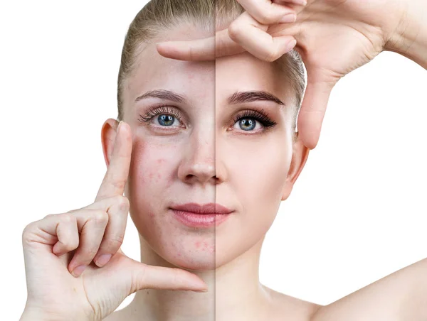 Junge Frau vor und nach Hautbehandlung und Make-up. Stockbild