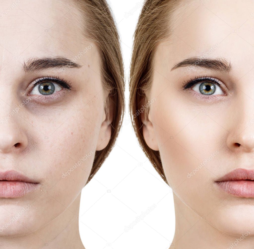 Woman with bruises under eyes before and after cosmetic treatment.