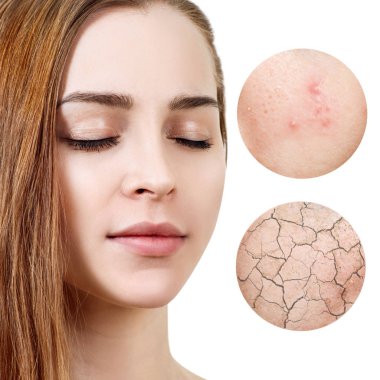 Daireler gösterir sorun cilt genç kadının zoom.