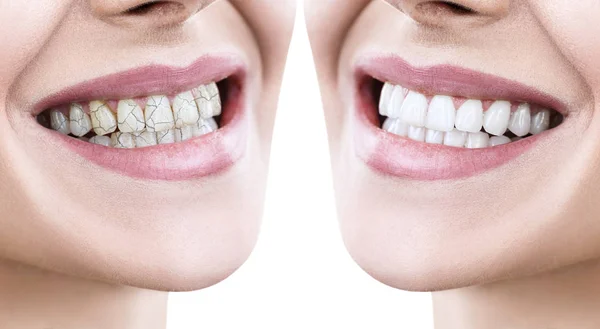 Dentes de mulher jovem antes e depois do tratamento . — Fotografia de Stock