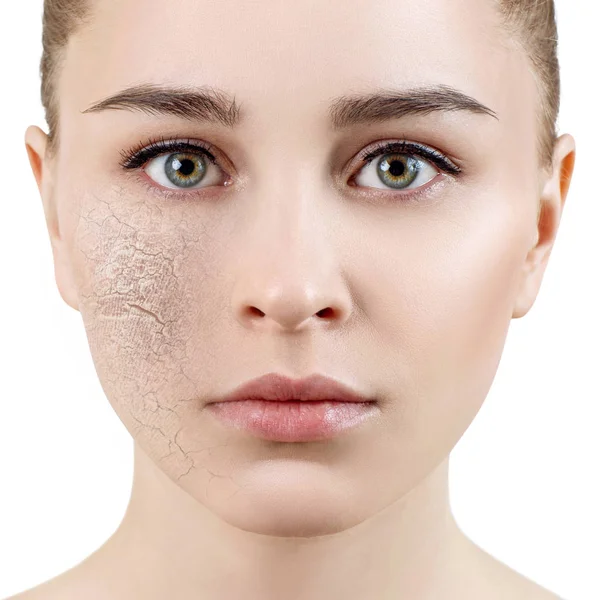 Young woman with dehydrated skin. — Stock Photo, Image