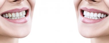 Tedavi öncesi ve sonrası genç kadının dişleri.