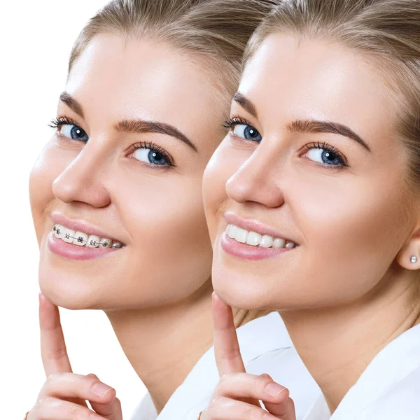 Hermosa sonrisa con dientes perfectos antes y después de los aparatos ortopédicos . —  Fotos de Stock