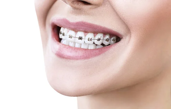 Mujer joven sonriendo con frenos en los dientes . — Foto de Stock