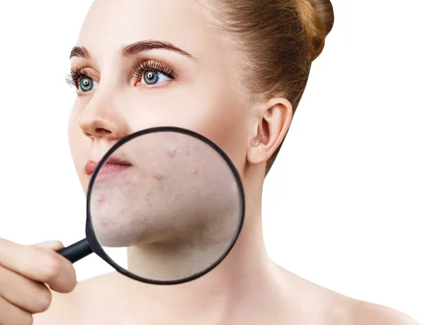 Giovane donna con lente d'ingrandimento mostra pelle con acne . — Foto Stock