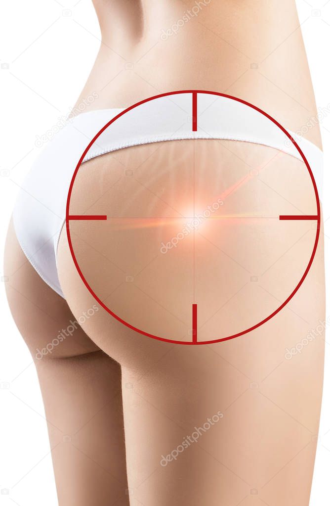 Female buttocks with laser ray into aim removes stretchmarks.