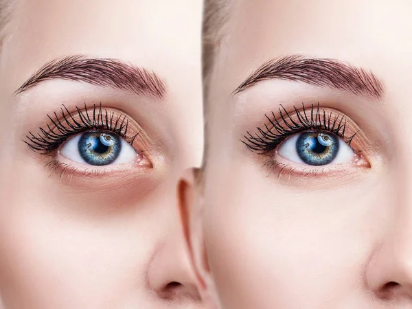 Yeux féminins avec ecchymoses sous les yeux avant et après le traitement . — Photo
