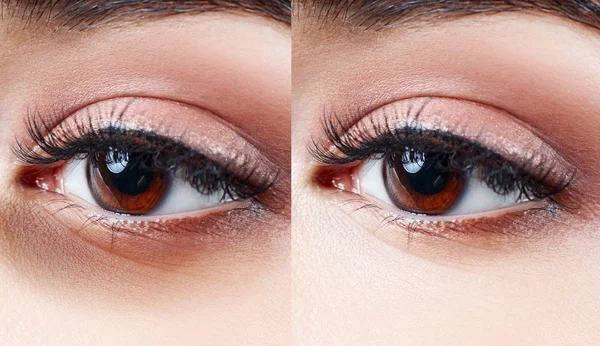 Mata wanita dengan memar di bawah mata sebelum dan sesudah pengobatan . — Stok Foto