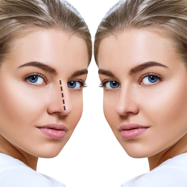 Nez féminin avant et après la chirurgie esthétique . — Photo