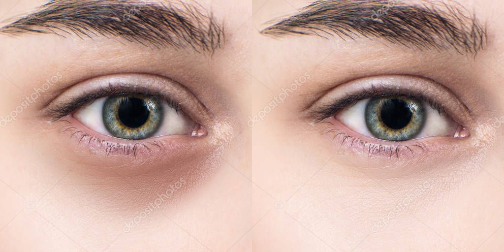 Ojos Femeninos Con Hematomas Debajo De Los Ojos Antes Y Después Del