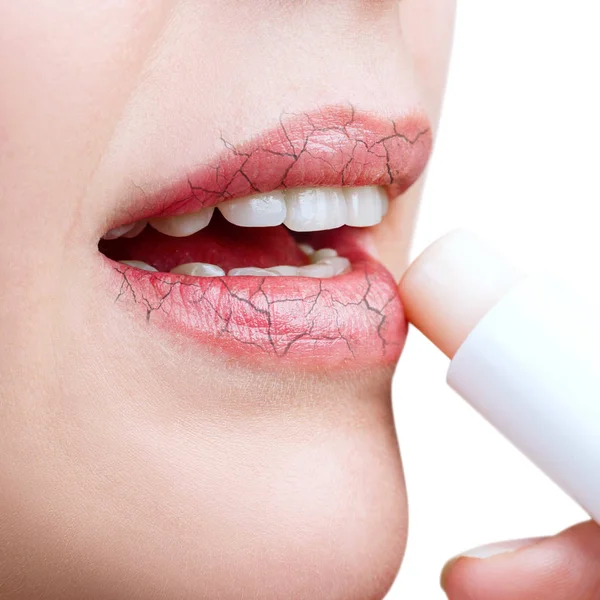 Vrouw aanbrengen van hygiënische Lipbalm op lippen met scheuren. — Stockfoto