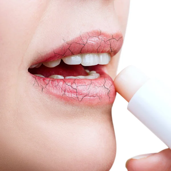 Çatlaklı dudaklara hijyenik lipbalm uygulayan kadın.