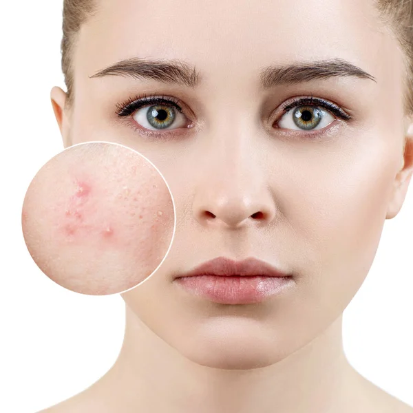 Young woman with acne skin in zoom circle. — Stock Photo, Image