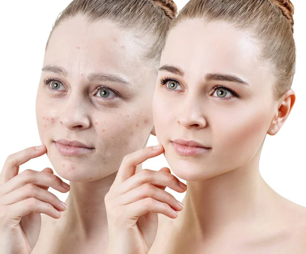 Mujer con acné antes y después del tratamiento y el maquillaje . —  Fotos de Stock