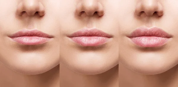 Lippen van jonge vrouw voor en na augmentatie. — Stockfoto