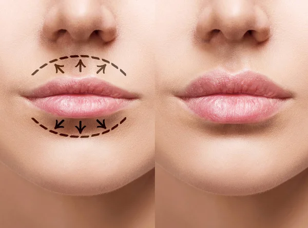 Usta młodej kobiety przed i po augmentacji. — Zdjęcie stockowe
