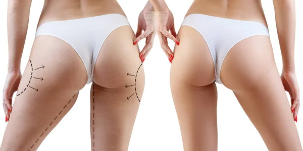 Fesses féminines avec des flèches avant et après la chirurgie plastique . — Photo