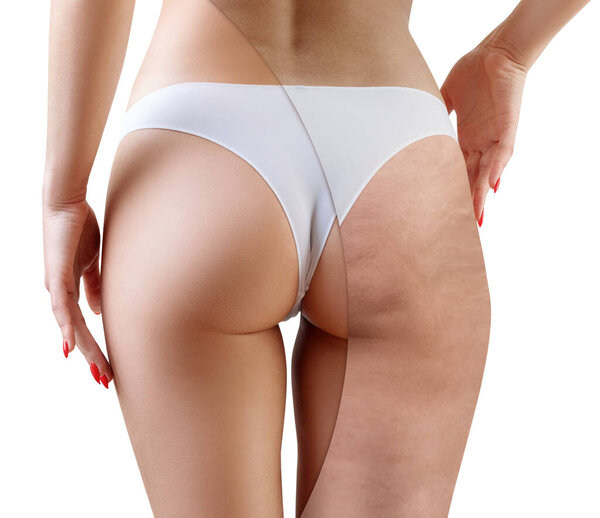 Female buttocks before and after cellulitis treatment.