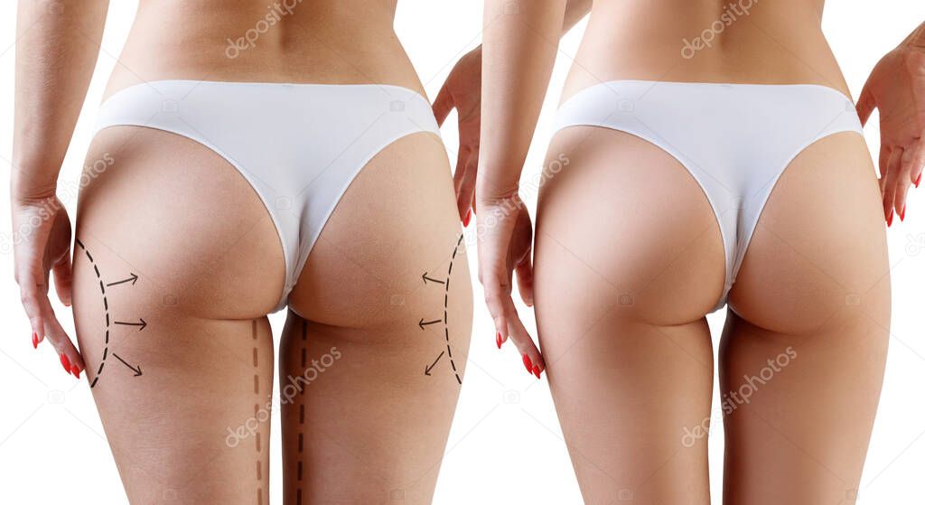 Female buttocks with arrows before and after plastic surgery.