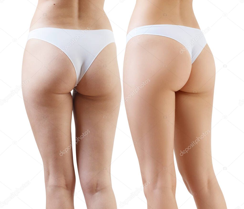 Female buttocks before and after cellulitis treatment.