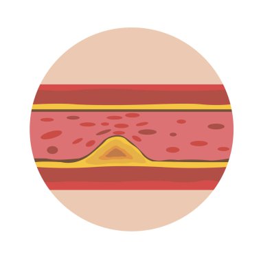 Kan dolaşımını engelleyen duvarlarında mevduat ile insan bir gemi vektör görüntü