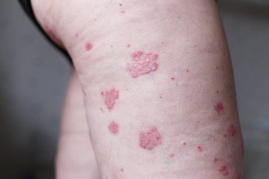 Alerjik döküntü dermatit egzama deri hasta bacak üzerinde. Sedef ve egzama deri ile büyük kırmızı lekeler. Sağlık kavramı