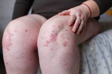 Kaşıntı ve el ile sedef noktalar çizilmeye Closeup kadın. Sedef veya egzama deride. Atopik Anti deri kırmızı lekeler ile