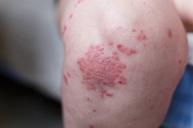 Alerjik döküntü dermatit egzama deri hasta bacak üzerinde. Sedef ve egzama deri ile büyük kırmızı lekeler. Sağlık kavramı