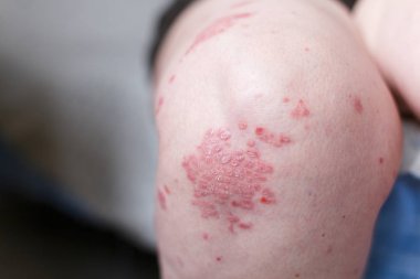 Alerjik döküntü dermatit egzama deri hasta bacak üzerinde. Sedef ve egzama deri ile büyük kırmızı lekeler. Sağlık kavramı