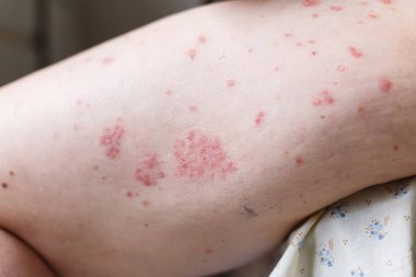Alerjik döküntü dermatit egzama deri hasta bacak üzerinde. Sedef ve egzama deri ile büyük kırmızı lekeler. Sağlık kavramı