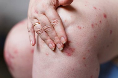 Kaşıntı ve el ile sedef noktalar çizilmeye Closeup kadın. Sedef veya egzama deride. Atopik Anti deri kırmızı lekeler ile