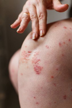 Kaşıntı ve el ile sedef noktalar çizilmeye Closeup kadın. Sedef veya egzama deride.