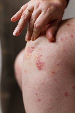 Kaşıntı ve el ile sedef noktalar çizilmeye Closeup kadın. Sedef veya egzama deride. Atopik Anti deri kırmızı lekeler ile