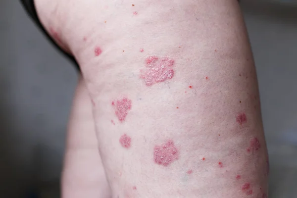Dermatite alérgica cutânea dermatite eczema pele na perna do paciente. Psoríase e pele de eczema com grandes manchas vermelhas. Conceito de saúde — Fotografia de Stock