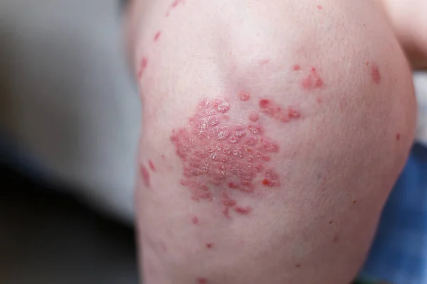 Allergic rash dermatitis eczema skin on leg of patient. Psoriasis and eczema skin with big red spots. Health concept — Stock Photo, Image