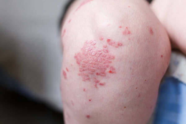 Allergic rash dermatitis eczema skin on leg of patient. Psoriasis and eczema skin with big red spots. Health concept