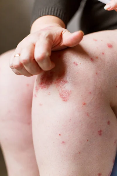 Primeros planos de las mujeres con picazón y arañazos puntos de psoriasis a mano. Psoriasis o eczema en la piel. Piel alérgica atópica con manchas rojas — Foto de Stock