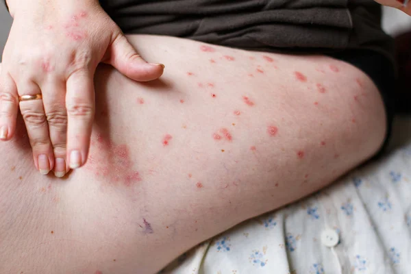 Mulheres close-up coceira e arranhando pontos da psoríase à mão. Psoríase ou eczema na pele. Pele alérgica atópica com manchas vermelhas — Fotografia de Stock