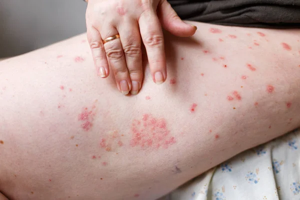 かゆみ、乾癬スポットを手で傷は、女性をクローズ アップ。乾癬やアトピー性皮膚炎肌に。赤い斑点でアトピー性アレルギー肌 — ストック写真