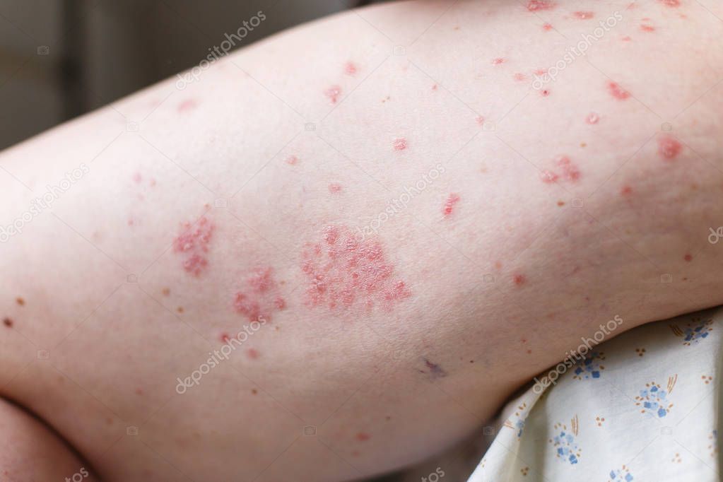 Allergic Rash Dermatitis Eczema Skin On Leg Of Patient Psoriasis And