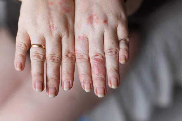 En bild av kvinnliga händer en svullen på grund av ett getingstick. Rött allergi fläckar på huden. Hälsokoncept — Stockfoto