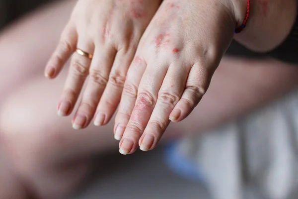 Ein Bild weiblicher Hände, die wegen eines Wespenstichs geschwollen sind. rote Allergieflecken auf der Haut. Gesundheitskonzept — Stockfoto