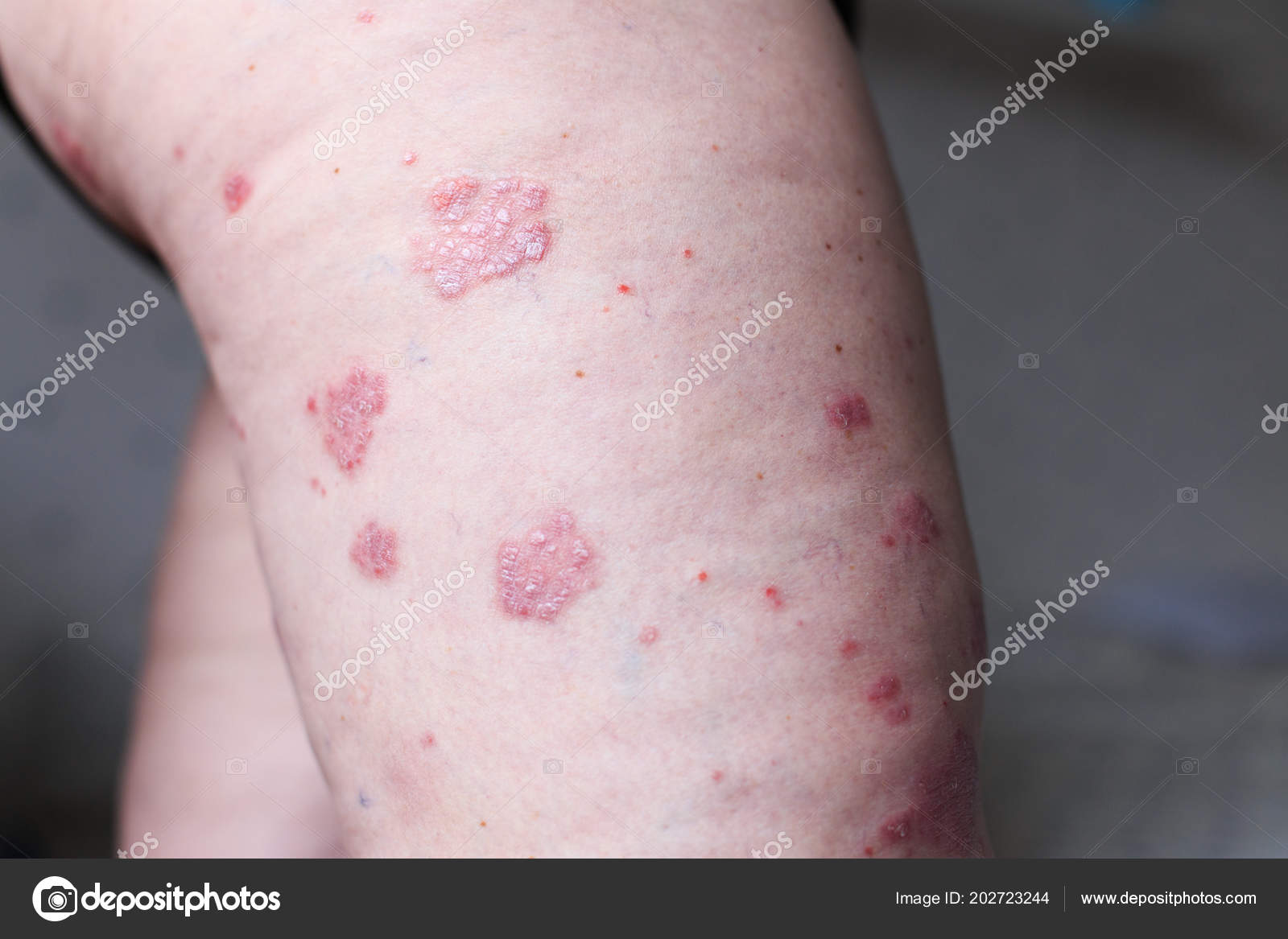 autoimmune psoriasis eczema)