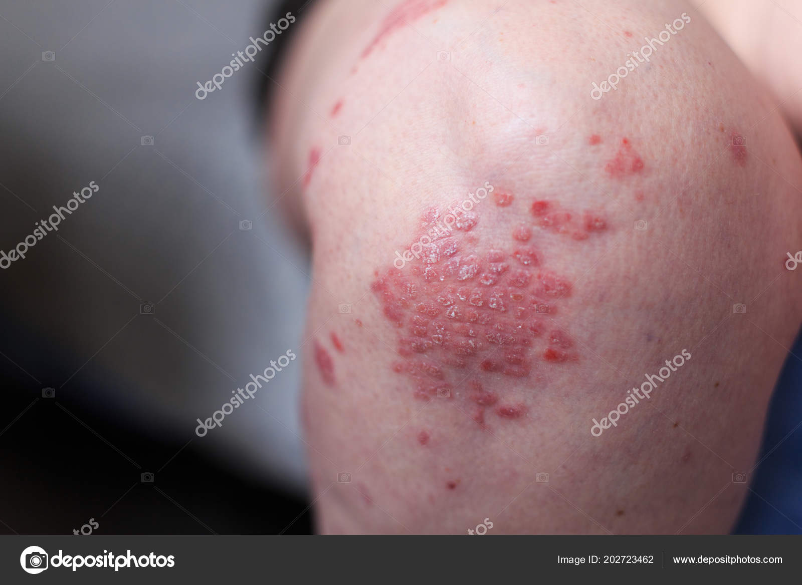 autoimmune psoriasis dermatitis)