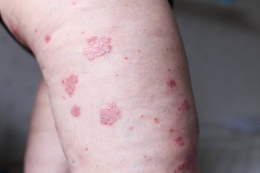 Psoriasis vulgaris etkiler deri, özellikle Tıbbi dergiler için detay fotoğraf otoimmün bir hastalıktır. Atopik dermatit veya egzama, ayak, deri iltihabı türüdür.