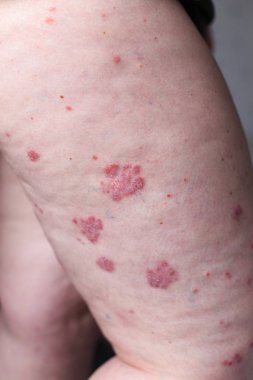 Psoriasis vulgaris etkiler deri, özellikle Tıbbi dergiler için detay fotoğraf otoimmün bir hastalıktır. Atopik dermatit veya egzama, ayak, deri iltihabı türüdür.