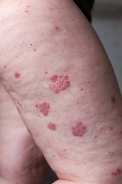 Psoriasis vulgaris etkiler deri, özellikle Tıbbi dergiler için detay fotoğraf otoimmün bir hastalıktır. Atopik dermatit veya egzama, ayak, deri iltihabı türüdür.